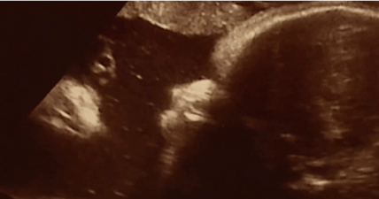 Jesus ultrasound