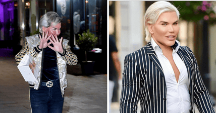 Human Ken Doll chemical peel
