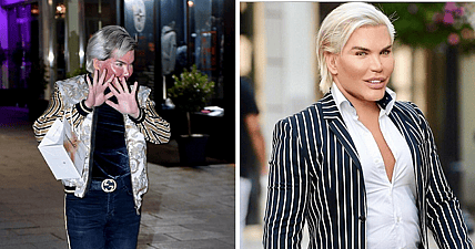 Human Ken Doll chemical peel