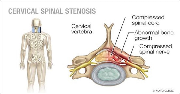 Spinal Stenosis