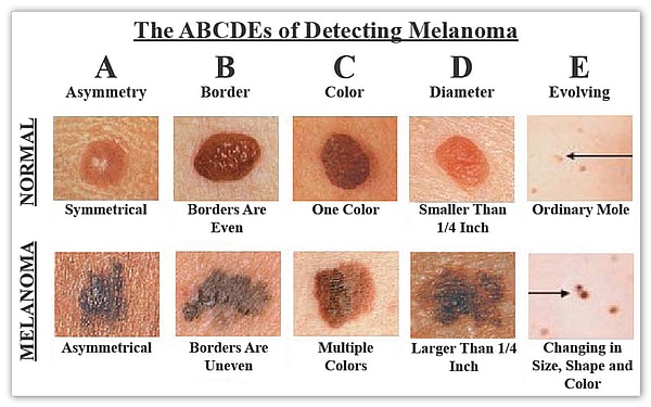 ABCDEs of Skin cancer