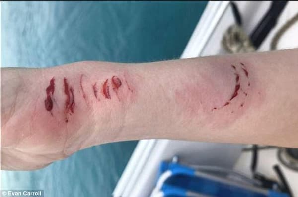 Sarah Illig Shark Bite