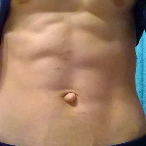 outtie belly button