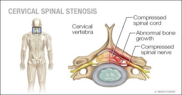 Spinal Stenosis