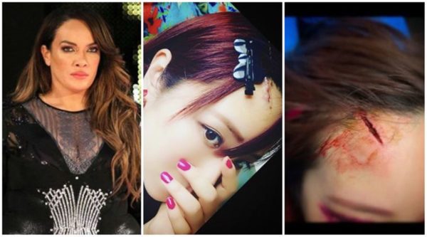 Kairi Sane took to social media to show her injuries